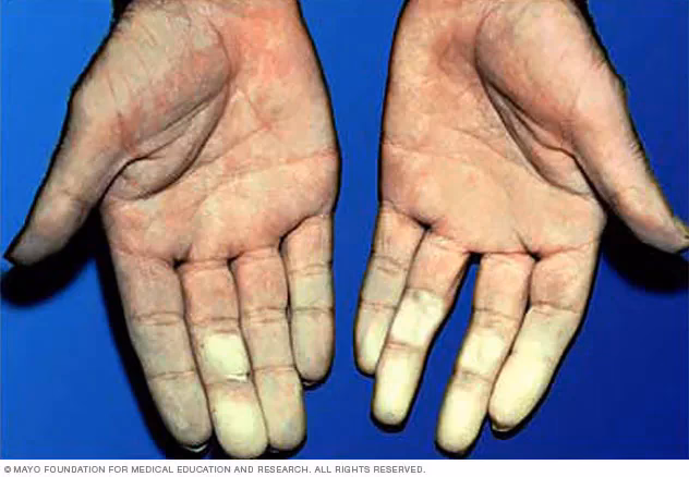 ¿Qué significa la enfermedad de Renault?