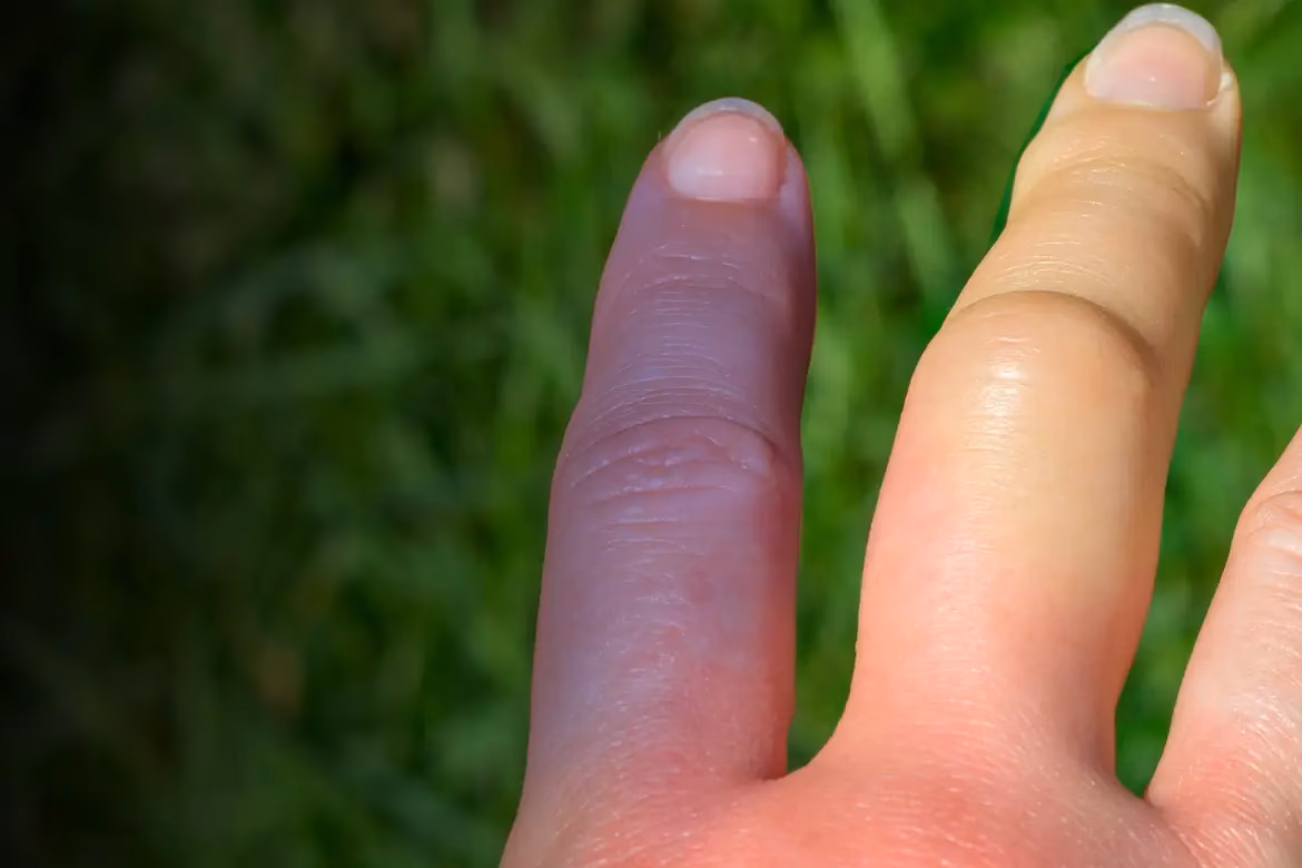 ¿Qué puede causar el síndrome de Raynaud?