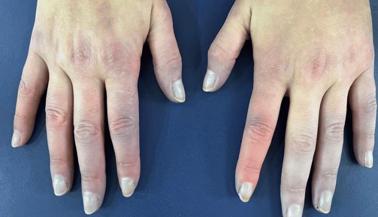 ¿Qué puede causar el síndrome de Raynaud?
