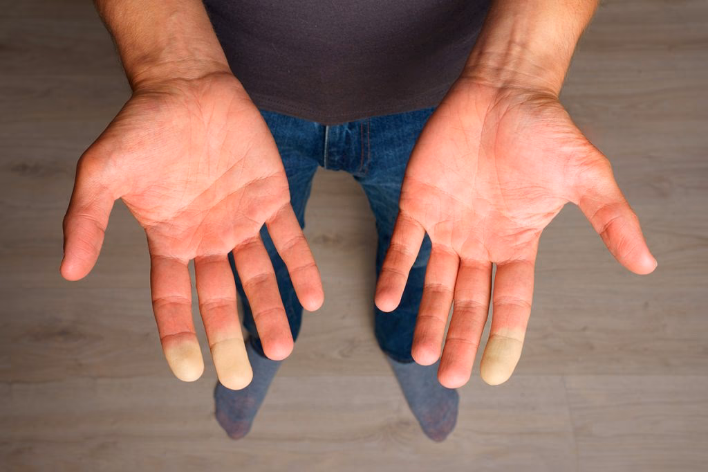 ¿Cómo diferenciar enfermedad de Raynaud y síndrome de Raynaud?